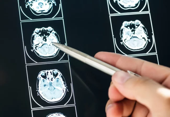 types of brain injuries types of brain injuries