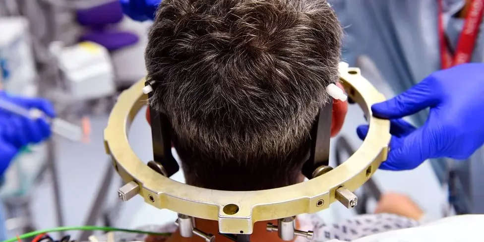 Stereotactic Brain Tumor Surgery Stereotactic Brain Tumor Surgery